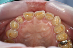 Tooth Attrition (Wear)