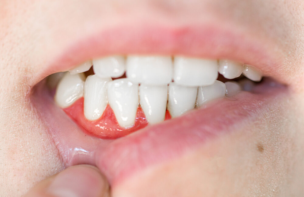 Severe Gingivitis: When to see your doctor