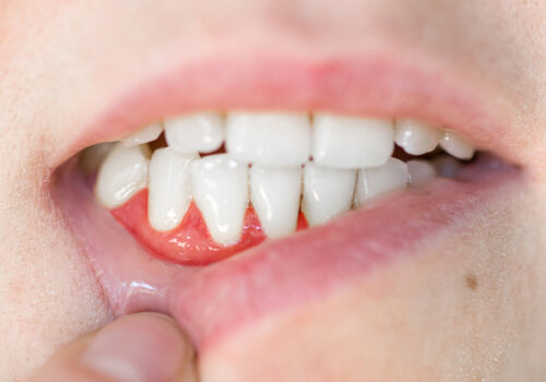 Severe Gingivitis: When to see your doctor