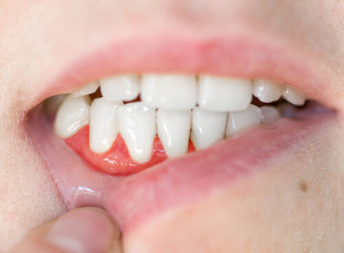 Severe Gingivitis: When to see your doctor