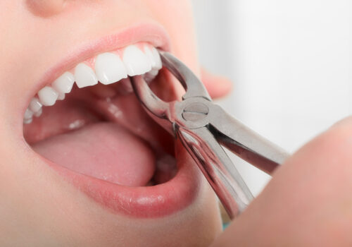 Day-by-Day Expectations After a Tooth Extraction (Timeline)