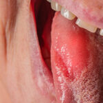 Explore Diagnosis, Treatment, and Self-Care for Burning Mouth Syndrome