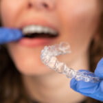 How are teeth retainer fitted?