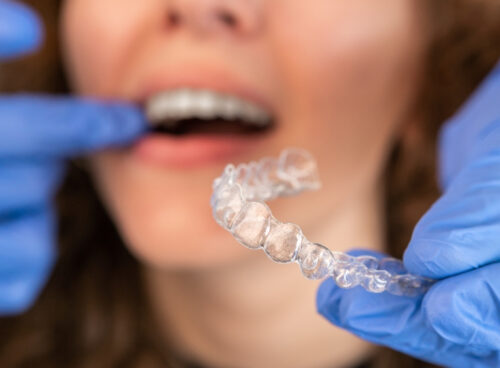 How are teeth retainer fitted?