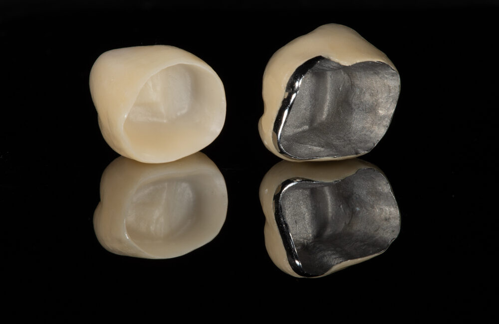 Dental Crowns: Purpose, Types, Procedure, Care, and Cost