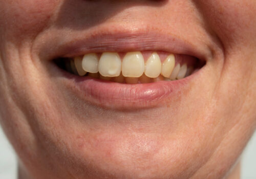 White Spots on Teeth - Causes, Treatment, and Prevention