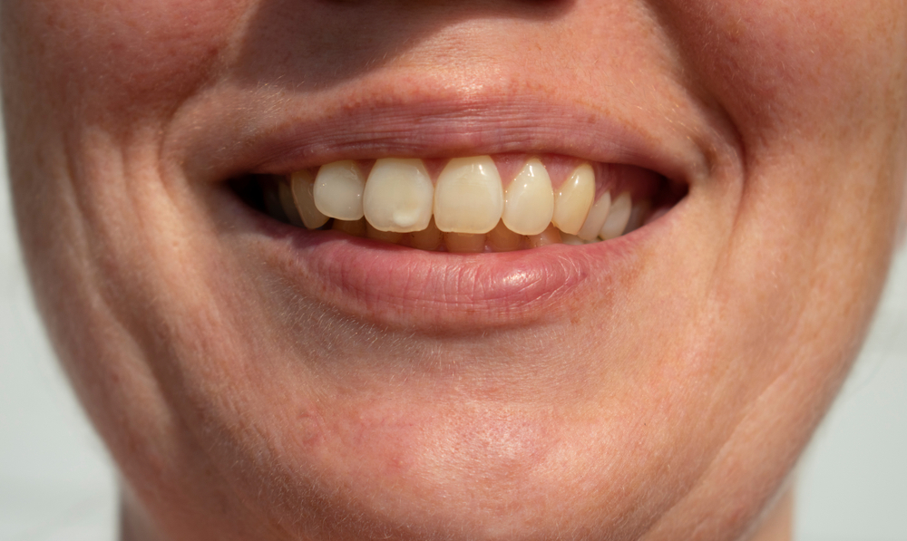 White Spots on Teeth - Causes, Treatment, and Prevention