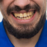 Causes of Tooth Discoloration and How to Prevent and Treat It?