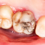 Why Amalgam Fillings Should Be Replaced With Resin Composite Fillings?