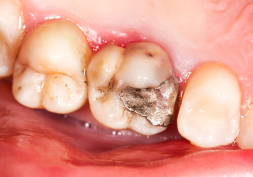 Why Amalgam Fillings Should Be Replaced With Resin Composite Fillings?