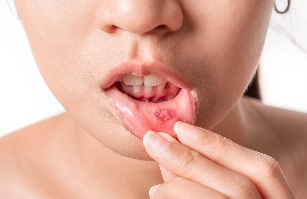 Mouth Ulcers: Types, Causes, and Symptoms