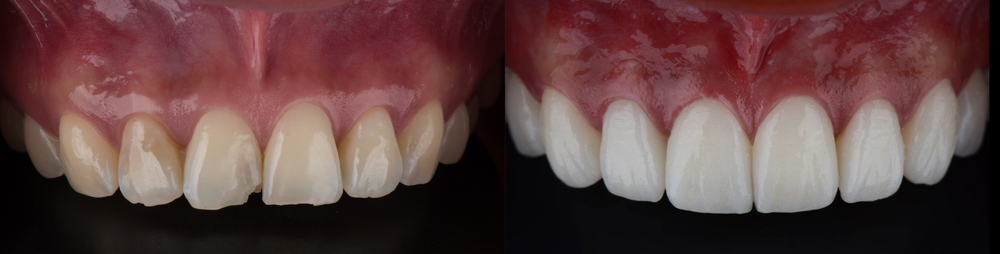5 Reasons to Consider Dental Veneers