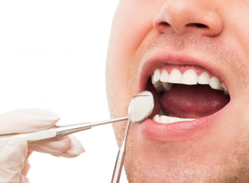 FAQs on Dental Bonding