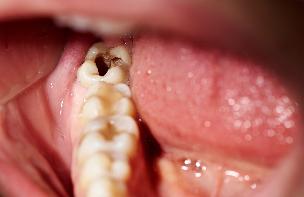 Cavities and Tooth Decay: Causes, Symptoms, and Prevention