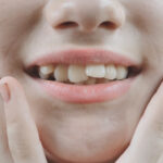 Common Causes of Crooked Teeth