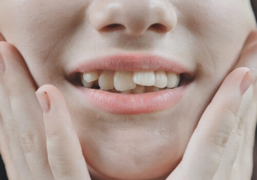 Common Causes of Crooked Teeth