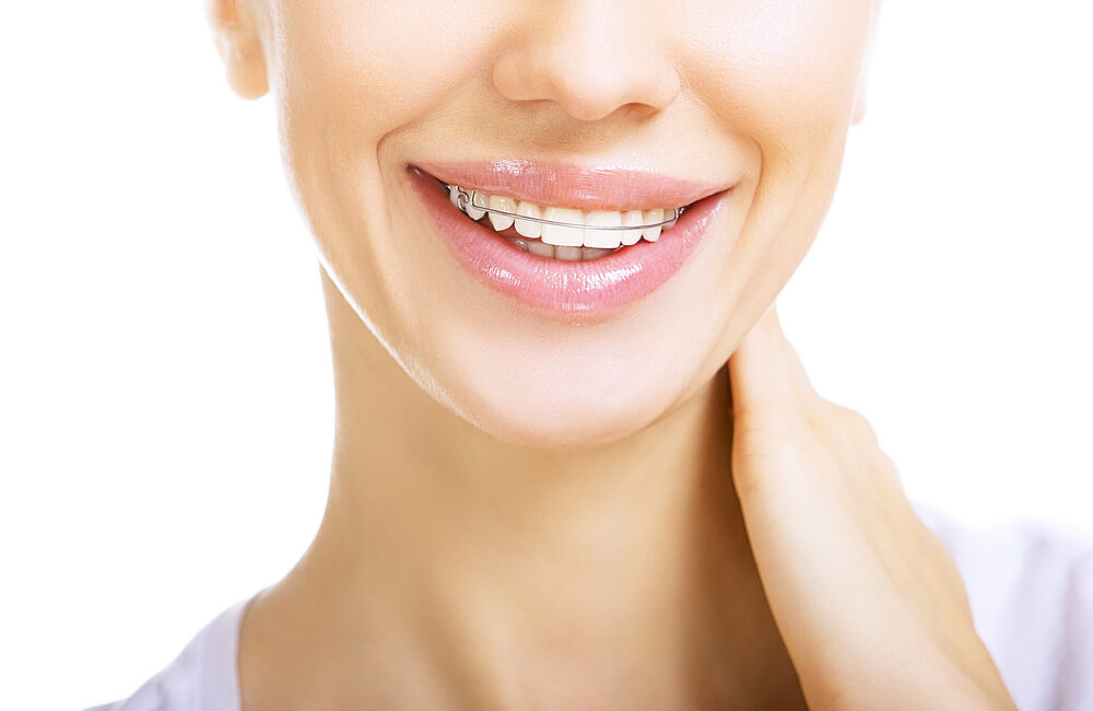 Frequently Asked Questions on Teeth Retainer