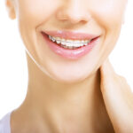 Frequently Asked Questions on Teeth Retainer