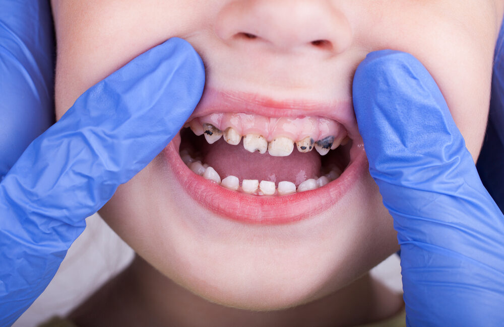 Why Some Kids Get Cavities Even If They Brush Their Teeth