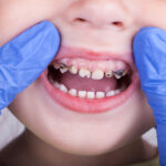 Why Some Kids Get Cavities Even If They Brush Their Teeth