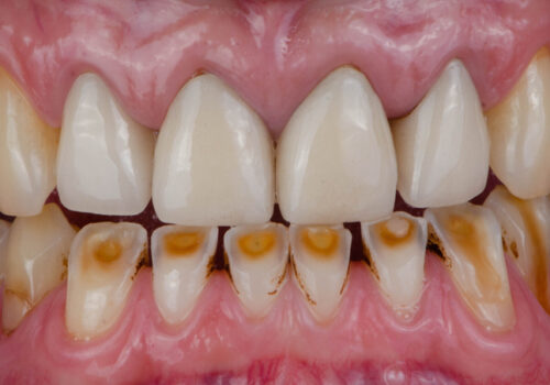 What is Dental Attrition?