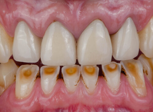 What is Dental Attrition?