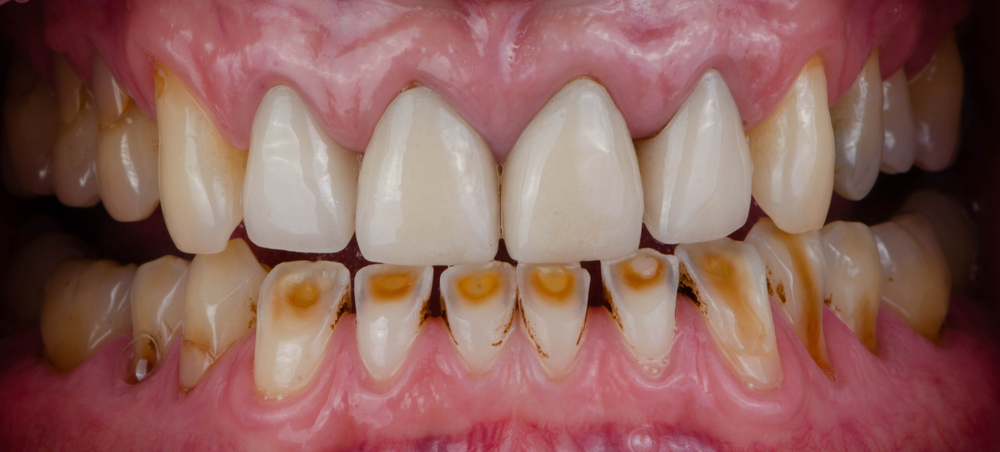 What is Dental Attrition?