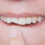 Chipped, Broken, or Cracked Teeth: What Are Your Options?