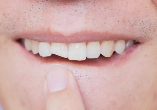 Chipped, Broken, or Cracked Teeth: What Are Your Options?