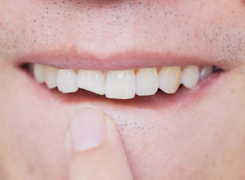 Chipped, Broken, or Cracked Teeth: What Are Your Options?
