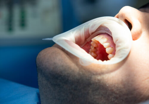 Common Teeth Conditions