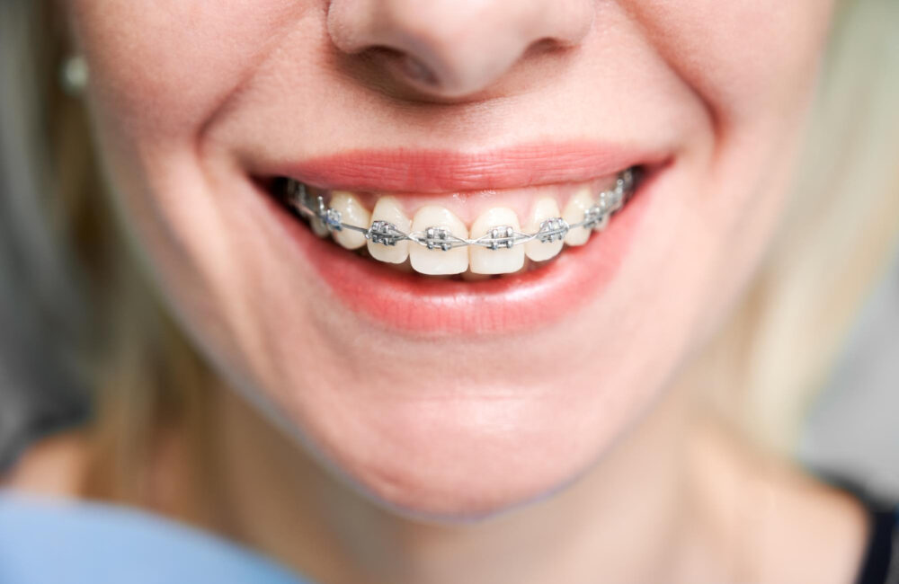 8 Tips To Eat Comfortably When You Have Dental Braces