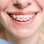 8 Tips To Eat Comfortably When You Have Dental Braces