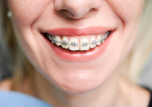 8 Tips To Eat Comfortably When You Have Dental Braces