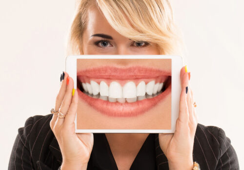 Composite Bonding vs Veneers