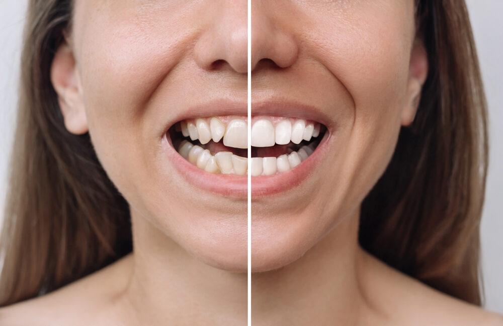 Porcelain Veneers or Braces? Which one to Choose?