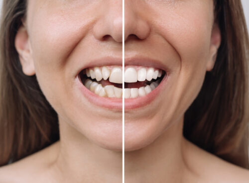 Porcelain Veneers or Braces? Which one to Choose?