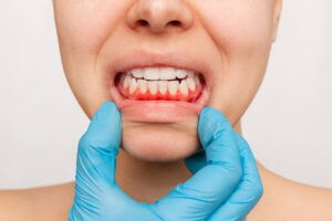 Symptoms of Gum Disease