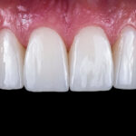 Pros and cons of veneers and crowns
