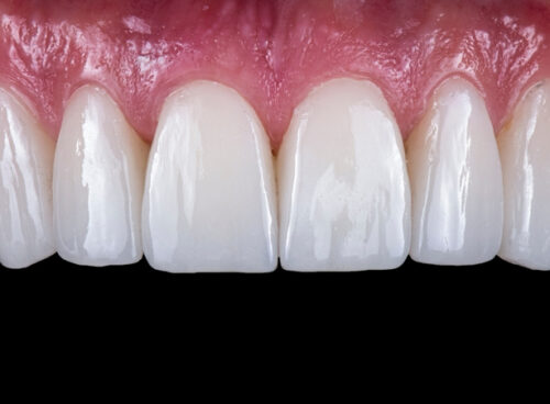 Pros and cons of veneers and crowns
