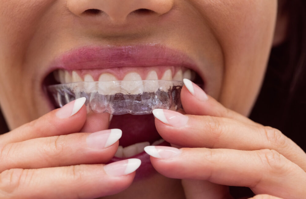 Invisalign for Seniors: Why It’s Never Too Late