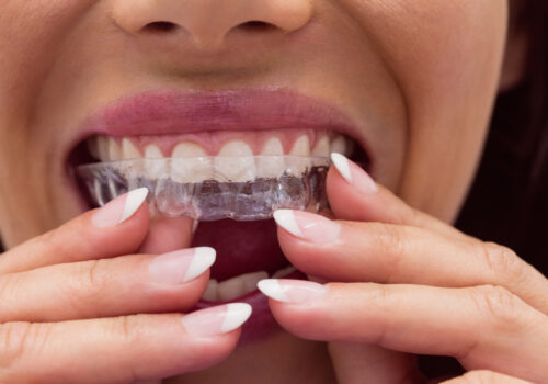 Invisalign for Seniors: Why It’s Never Too Late
