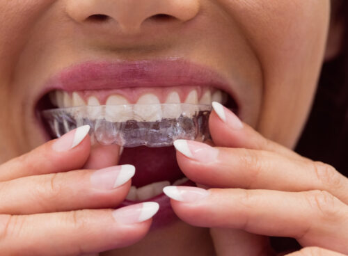 Invisalign for Seniors: Why It’s Never Too Late